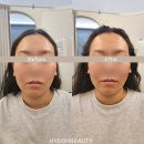 현메디칼 | 동탄 두피관리 리프팅 관리 [현뷰티] 스칼프핏 헤드스파 후기