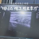 두번째 테니스 레그 비복근 파열 후기
