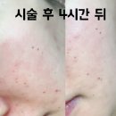 청담뷰의원 | 청담 오가나셀의원 청담 피부과 여드름흉터 피부교정 후기 (울트라클리어 + 큐어트라 + 큐어젯) 내돈내산