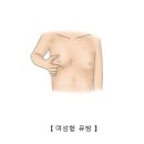 여성형 유방[Gynecomastia]유방내분비질환 이미지