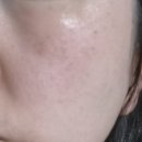 가원피부토탈케어 | (광고)여름철 피부관리,스톨존 토탈 케어크림 재구매 후기