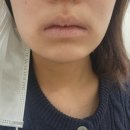 닥터미소의원 | [서울 태릉] 얼굴커짐 이슈 / 노원역 닥터에버스/ 노원 피부과/ 노원역 보톡스/ 노원역 피부과