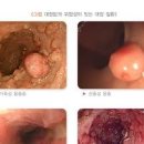 대장 선종, 암 발생 가능성 (크기, 제거) 이미지