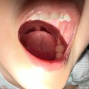 향적산 한상 | 5살 편도제거수술후기 : 대전 유성선병원 / 수술 6일차-15일차