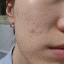 디엔에이의료기기 | 내돈내산 병풀엑소좀 콜라겐 피부과마스크팩 헤르세디아 마스크팩 사용후기 추천