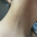연세의원 | 서울 3대 편평사마귀 전문 합정역 연세보드미의원 피부과 치료후기 예약방법 1~6일차 내돈내산