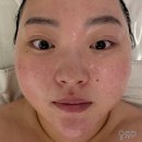 219-운정3-219 | 운정에스테틱 추천 | 붉은기진정 물방울초음파 라라필 후기