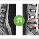 허리 디스크 원인 및 허리디스크 증상 이미지