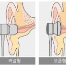 외이도염 원인 외이도염 통증 이어폰 보청기 외이도염 이미지