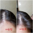 모발이식 전문병원 사용&lt;더블랙&gt; 탈모방지 샴푸