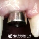 히든치과기공소 | 부러진 앞니 치아, 임플란트 수술 티 안 나게 받고 싶다면? 동대문구 치과 추천 (feat. 수면 마취 시스템)