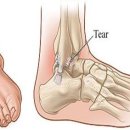 발목 자주 삐면 -＞ 만성 발목염좌 이미지