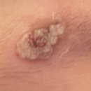 11545-08-02-14 | 얻은 희망을 공유합니다.눈썹 선천성모반 레이저치료 2년 후기 2탄 - 치료 후기 (feat. 꿀템 밴드 추천)