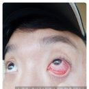 다인약국 | 눈병 .. 유행성 결막염 .. 인천 서구 가좌동 안과 - 다인안과 진료 다녀옴 ㅠ.ㅜ