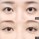 도도성형외과 - 동대문구 천호대로 425 | 뒤밑트임으로 삼백안 교정이 가능할까?(시선성형외과 후기)