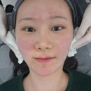 서울미래의원 | 신사역피부과 세레아의원 얼굴지방분해주사 세레아주사 맞고 온 후기