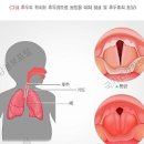 호흡기 질환 후두염 기관지염 인두염 이미지