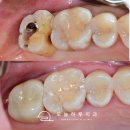 LC산업 | 장지동 치과 인접면 충치 치료, 크라운까지 한 번에! 실제 사례 소개