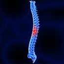 운동부족과 척추압박골절의 관계 이미지