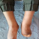 참의수족보조기 이미지