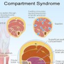 구획증후군 원인 증상 급성 구획증후군 치료 구획증후군 예방법 이미지