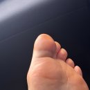 발가락 골절 핀 수술 오산 버팀병원