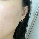 강서구-30 | 강서구 여드름관리 후기 무너진 피부장벽과 화농성 트러블 진정! 30년 내공 강서하얀피부