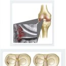 무릎 반월상연골판의 해부학적구조와 손상진단 이미지