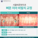 삐뚤한이바르게치과교정과치과의원 | 부산 치아교정 삐뚠 치아 비발치 교정