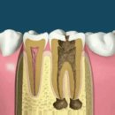 치아 신경치료 과정 이미지