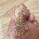 백선세탁 | 발바닥한포진무좀과는 다릅니다.(실제치료방법)