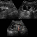 Renal stone with twinkling artifact and hydronephrosis 이미지