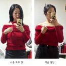 에이비 시스템 | [후기/윤곽리프팅] 하루만에 오프숄더 "진짜" 가능, 디또뷰티 윤곽리프팅 솔직후기