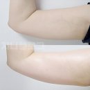 (주)포톤웨이브 | 셀룰라이트 관리하는 가정용 고주파마사지기 추천/ 피트미 내돈내산 후기, 효과, 탄력케어