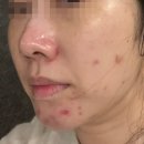 재생한의원 | 상계역 피부과 한의원 노원여드름흉터 치료 후기 천연재생침 내돈내산