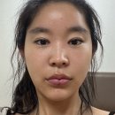 강남 신사역 피부과 인모드 fx forma 포마 후기 효과