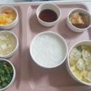 손목통증 수술 1일차 tfcc 척골 단축 고려대 안산