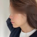 셀럽성형외과의원 | 확실한 인중축소를 원한다면 흉터없는 듀얼인중축소