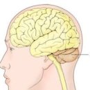 소뇌위축증 척수소뇌실조증 원인 증상 방법 소뇌의 중요성 이미지