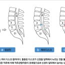 추간판 협착증 이미지