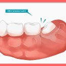 사랑니 질환[wisdom tooth] 이미지