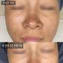 콜드플라 | 여름 휴가,여행,물놀이,화상, 손상된 피부/ 구미 콜드플라 관리 후기/ 주주모어