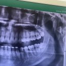 연수새움치과의원 | 사랑니 발치 후기 (디지게 아프다...^^)