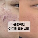 신생한의원 | 내돈내산 강남역여드름한의원 다녀온 후기! 남동생 여드름흉터시술 전후 및 부작용
