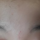 메리트피부과의원 | 여드름치료 방배동에 있는 메리트피부과의원에서 받았어요