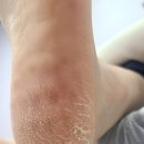 의정부발각질, 여름 전 샌들 신기 전에 꼭 받은 패디플래닝 후기