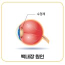 광주백내장수술 알아보신다면-증상 비용 수술방법 이미지