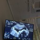 씨유검사빌리지점 | 강북삼성병원 제왕절개 (Day 1-2)