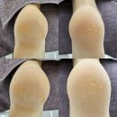 서곡해뜰어린이집 | 👣 쌍둥이 엄마 😭 임신과 육아로 악화된 발 앞꿈치 굳은살 통증, 발바닥 굳은살 집중 케어 후기