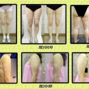 정메디컬 네이버블로그